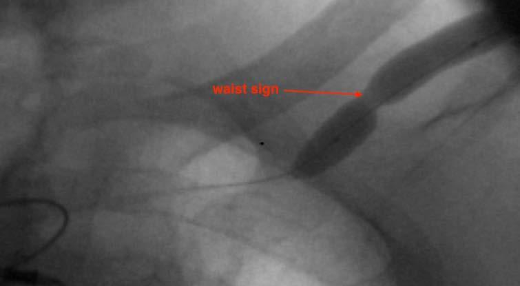CAS balloon angioplasty This patient was