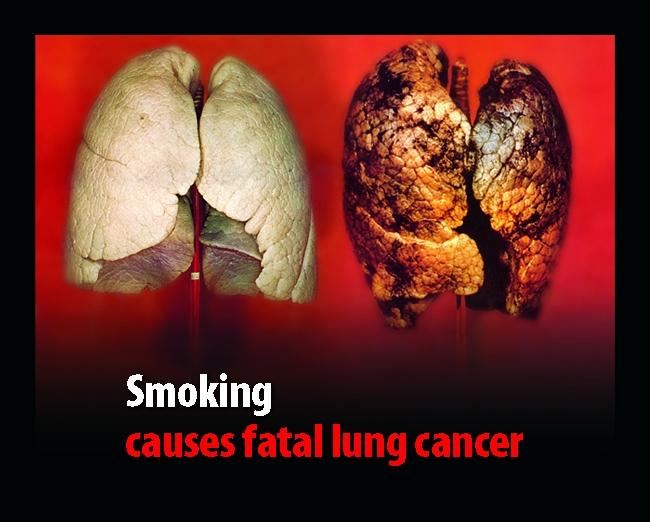 Background Diseases caused by smoking (National Cancer Inst.