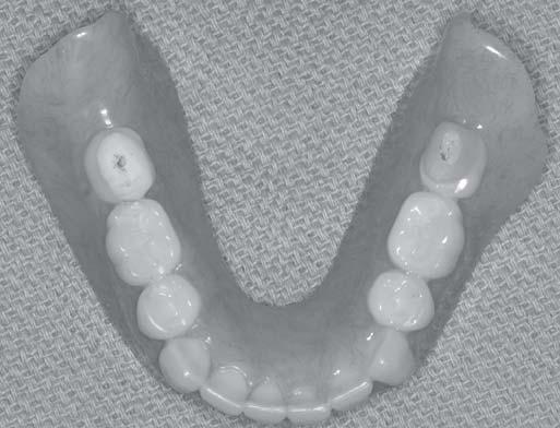 This resulted in an opening of the articulator by 2 mm at the level of incisal guide pin.
