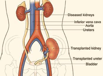What Is A Kidney Transplant?