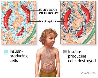 Insulin labelling Insulin labelling - pancreas T1D subject