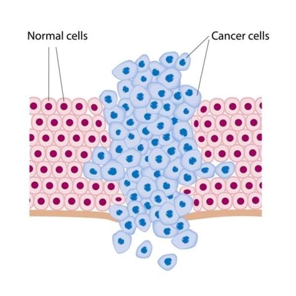 A Cancer Cancer is when abnormal cells divide in an