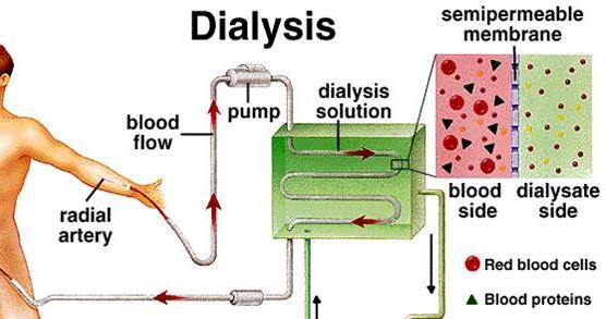 Kidney failure - dialysis If a persons kidney stops working properly there are 2 options: 1) Dialysis 2) Kidney transplant Dialysis Treatment by dialysis restores the concentrations of dissolved