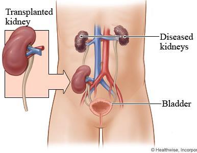 Kidney failure kidney transplant Key words: Antigen proteins on the surface of cells which identify a cell as self or foreign to the body Antibody - protein used in the immune response to fight off