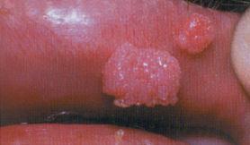 they may be seen intraorally Clinical presentation: - Present as multiple pink nodules which grow and