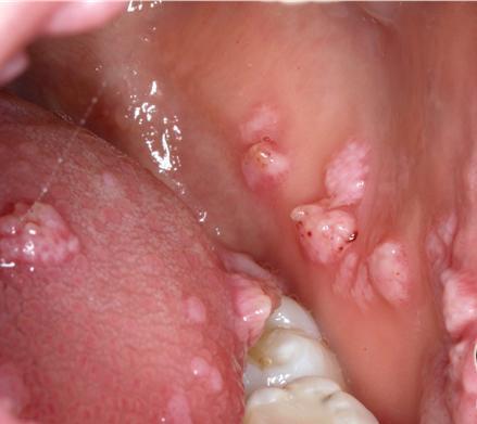 - In some patients, they are an oral manifestation of HIV infection - Most of the time venereal warts have flat surface (don t
