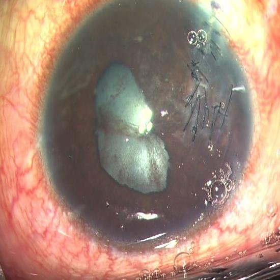 Sudden deepening of anterior chamber with momentary