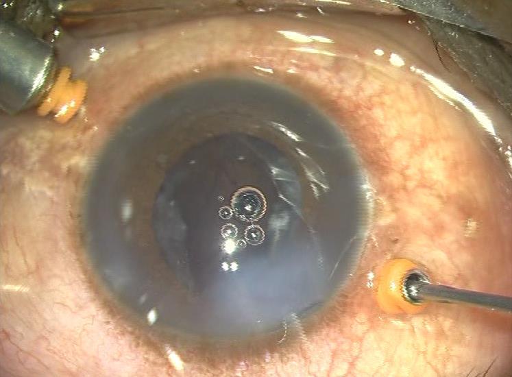 COURSE OUTLINE Introduction to the surgical nightmare of intraoperative posterior capsular dehiscence Videos showcasing intraoperative