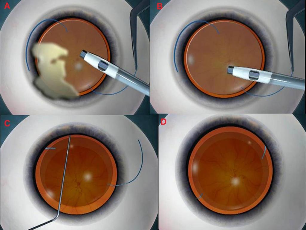 the iris and the trailing haptic lies extruded at the corneal