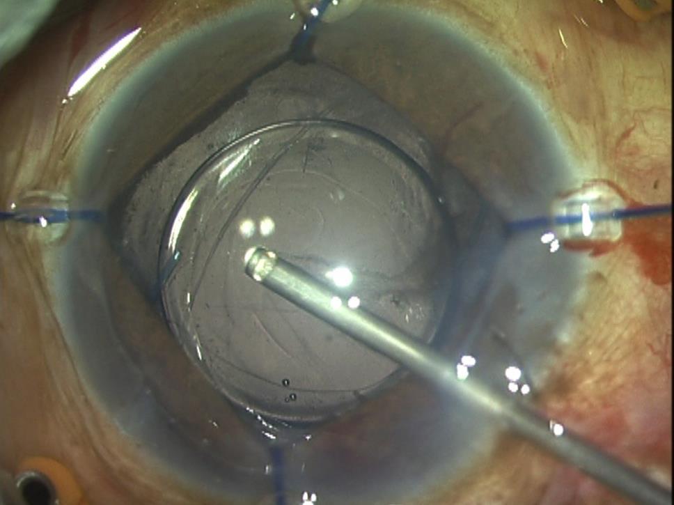 In IOL scaffold, the IOL is either placed over the iris or the anterior capsular rim from where it acts as a