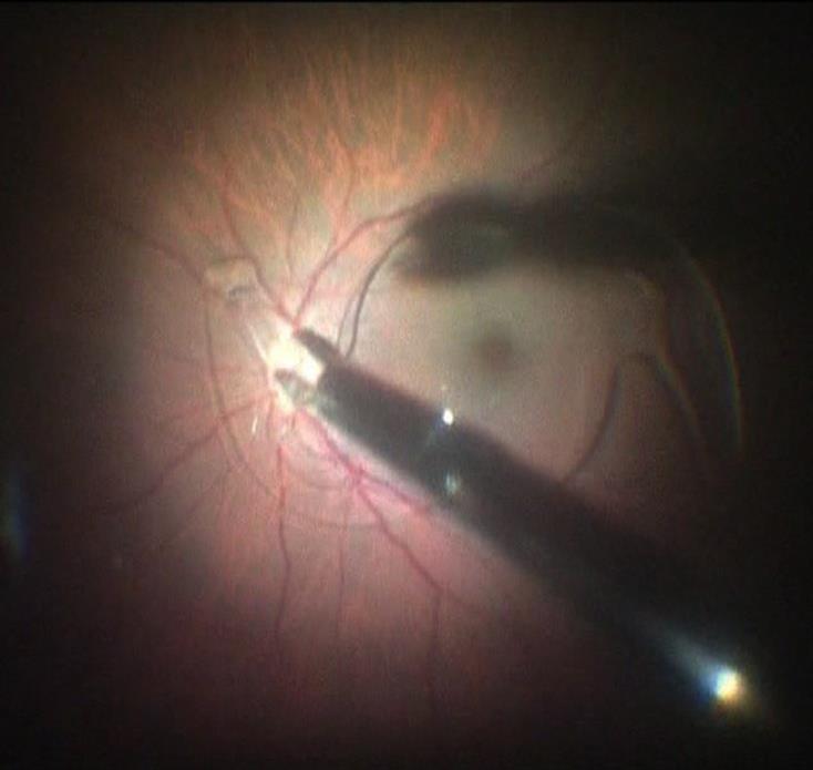 requires lot of surgical expertise to avoid the risk of retinal
