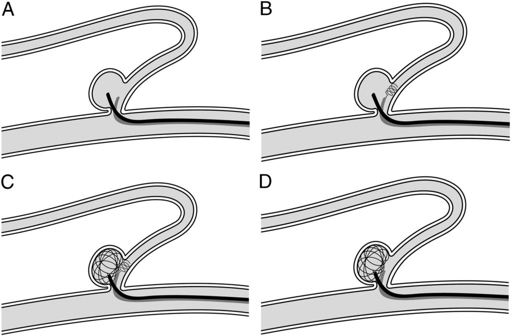 Fig 1. A, Microcatheter for coil delivery to the aneurysmal sac; second microcatheter delivering the protection coil at the orifice of the branch artery.