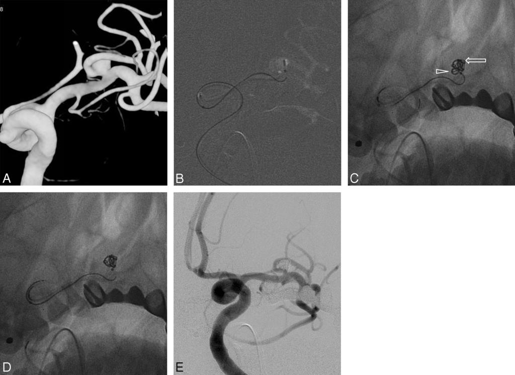 Fig 2. A, 3D reconstruction image of a wide-neck M1 aneurysm. B, Microcatheter at the entrance of the branch artery; a second microcatheter in the aneurysmal sac.