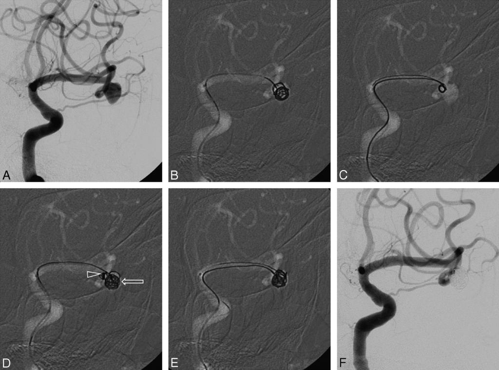 Fig 3. A, MCA bifurcation aneurysm seen with conventional angiography. B, Coil protruding into the parent artery (an attempt to form a frame with the complex coil by using dual microcatheters).