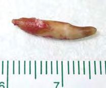b) The tooth was surgically removed using a gingival flap technique, debridement and flushing of the root cavity