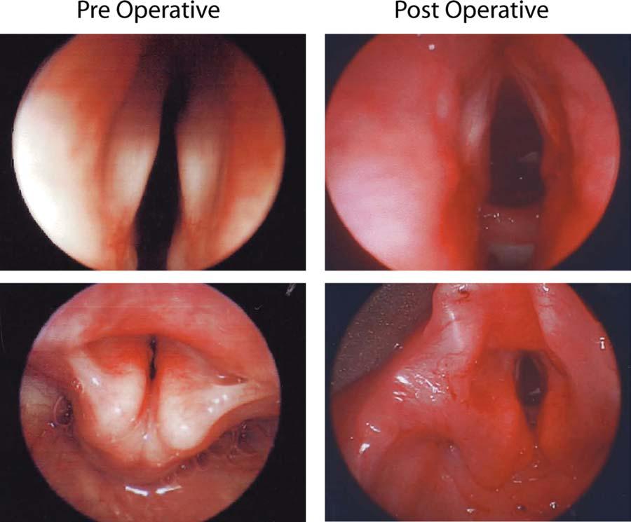 Fig. 3. Preoperative (A) and postoperative (B) photographs demonstrate the significant posterior expansion after graft placement.