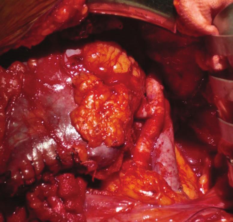Case Reports in Transplantation 3 Figure 4: The horseshoe kidney after transplantation into the recipient. The edge of the isthmus was sutured (arrows).