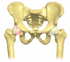 Other factors can include: A previous hip injury Repetitive strain on the hip Improper joint alignment Being overweight Exercise or sports-generated stress placed on the hip joint What causes the