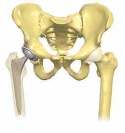 femoral stem and head The goal of total hip replacement is to increase mobility and ability to perform daily activities. Components of a hip replacement What is MAKOplasty Total Hip Replacement?
