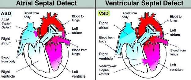 Left to Right Shunts Uncomplicated ASD/VSD/PDA without pulm.