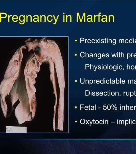 Pregnancy in Marfan Preexisting medial changes Changes with pregnancy Physiologic, hormonal