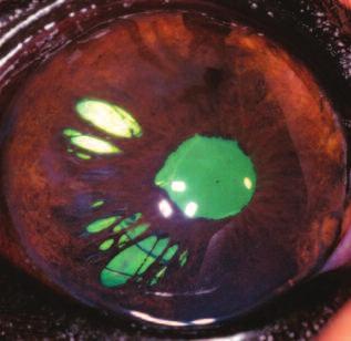 This patient had cataract surgery, and the edge of the prosthetic lens is visible through the holes in the iris.