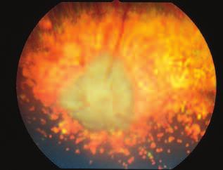 Compendium November 2003 Cataract Evaluation and Treatment in Dogs 821 Figure 16 Severe retinal degeneration (progressive retinal atrophy) in an 8-year-old castrated male miniature poodle.