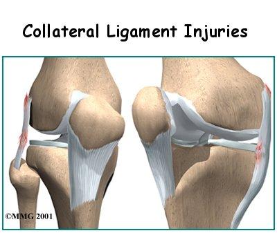 4 Collateral (outside) ligament strains /