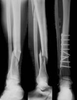 7 Fracture through the shaft of the tibia, with An accompanying fracture to the proximal area of the fibula, requiring internal fixation of the tibia Assessment Assessing the gait of the patient eg: