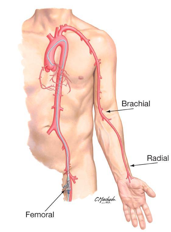 Your Drug-Eluting Stent Procedure (continued) Additional options for catheter introduction are the arm / brachial approach (incision is made on the inside of your elbow) and the wrist / radial