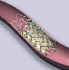 Your Drug-Eluting Stent Procedure (continued) Step 2: The balloon is then inflated and this expands the stent, pressing it against the coronary artery wall.