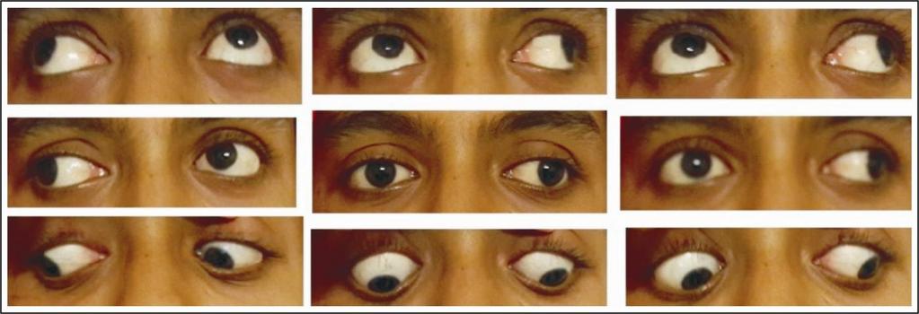 2 (A): A 15-year-old girl with an alternate exotropia of 70Δ and a V-pattern of