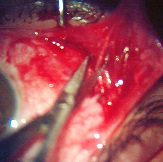 55%) 1 Filmy adhesions easily separable with blunt dissection. 2 Mild to moderate adhesions with freely dissectible plane.