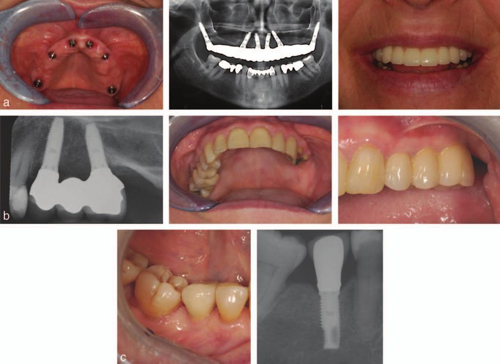 Why Guided? TABLE 2 Implants by treatment and location Immediate Loaded Exposed Submerged Anterior maxilla 7 (8.8%) 6 (7.5%) 0 (0.0%) 13 (15.8%) Posterior maxilla 21 (26.3%) 6 (7.5%) 0 (0.0%) 27 (33.