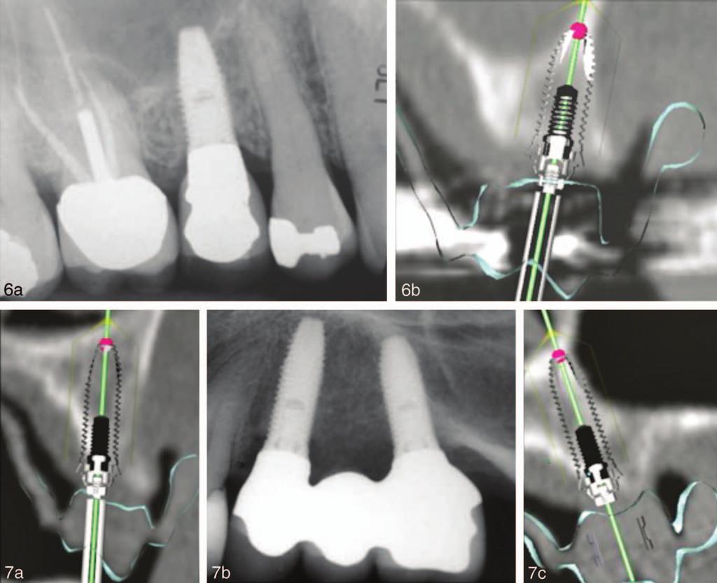 Schnitman et al FIGURES 6 AND 7. FIGURE 6. Single tooth implant in maxillary 2nd premolar area.