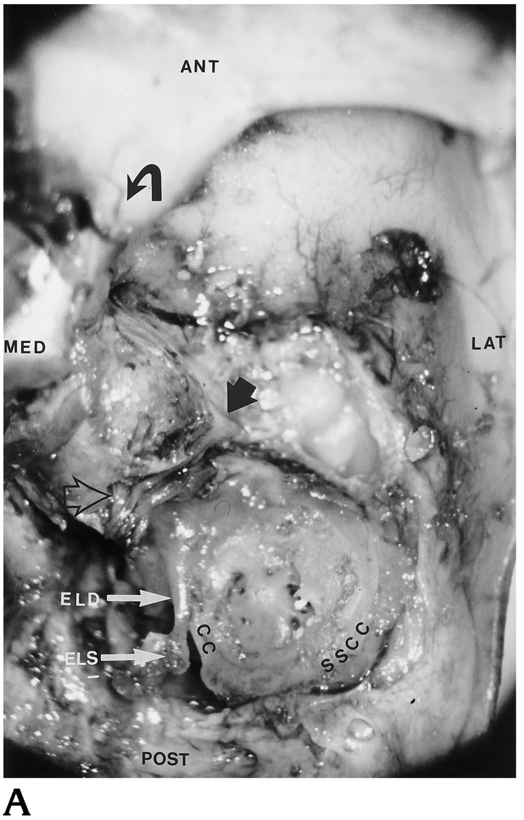 1476 NEMZEK AJNR: 17, September 1996 Fig 12. Endolymphatic duct and sac. A, Fetus, gestational age 18 weeks.