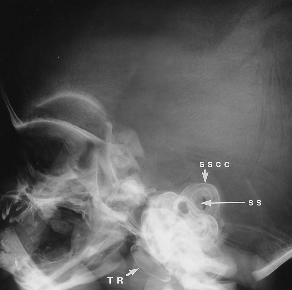 1472 NEMZEK AJNR: 17, September 1996 Fig 8. Fetus, gestational age 22 weeks 3 days. Lateral plain radiograph of the skull shows a large subarcuate space beneath the superior semicircular canal.