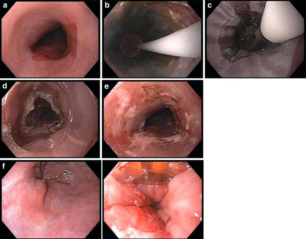 66 Page 4 of 10 Curr Surg Rep (2014) 2:66 Fig. 1 a Long segment circumferential Barrett s esophagus. b Endoscopic view of Barrett s esophagus treated with the HALO 360 balloon electrode.