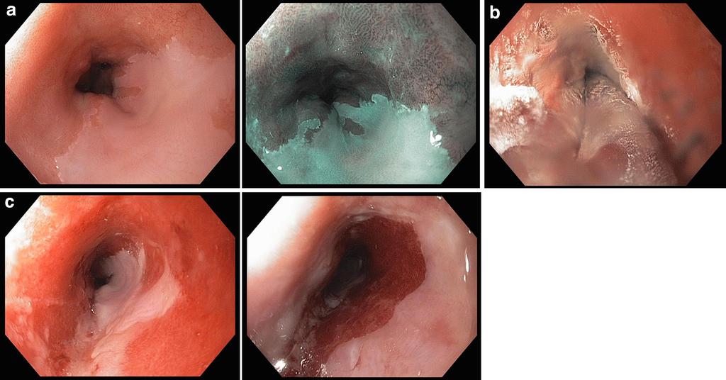 66 Page 6 of 10 Curr Surg Rep (2014) 2:66 Fig. 2 a Endoscopic appearance of a Barrett s island, b cryoablation treatment, c healing after cryotherapy Fig.
