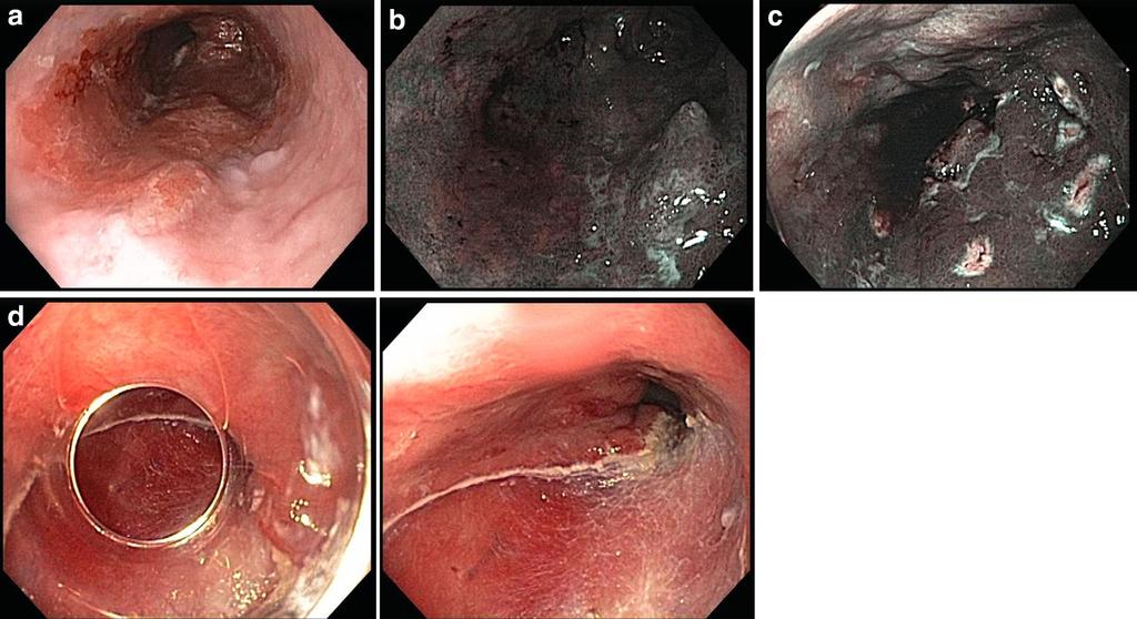 c Cautery marks the margins of resection, d post-resection appearance Lesions amenable to EMR must be superficial (Tis-T1) and small enough to be completely resected