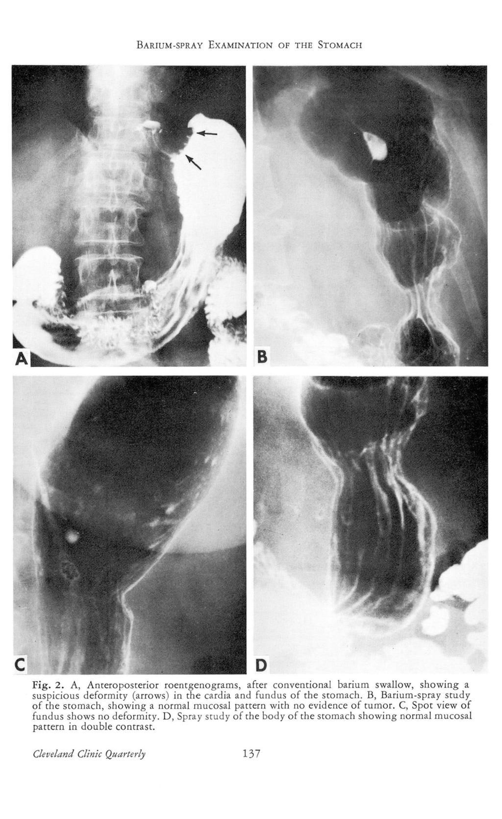 BARIUM-SPRAY EXAMINATION OF THE STOMACH Fig. 2. A, Anteroposterior roentgenograms, after conventional barium swallow, showing a suspicious deformity (arrows) in the cardia and fundus of the stomach.