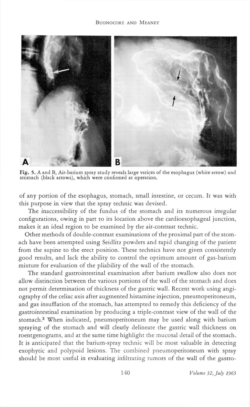 BUONOCORE AND MEANEY Fig. 5. A and B, Air-barium spray study reveals large varices of the esophagus (white arrow) and stomach (black arrows), which were confirmed at operation.