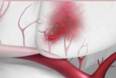 (VIDEO) Stroke is an interruption of blood flow to the brain.