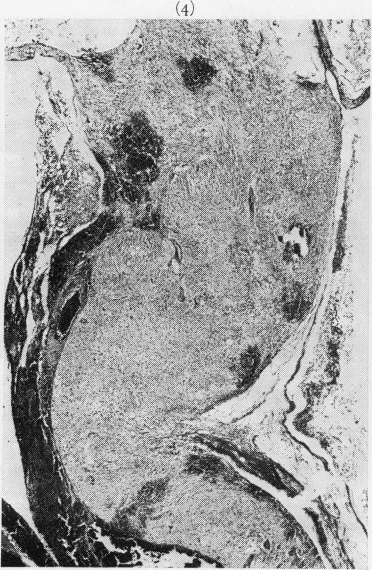 490 L. J. Martyn and D. L. Knox (4e I.~~~~~~~~~~~~~~~~~~~~~~~~~~~~~~~~~~~~~~~~~~~~o ~~~~~~~~~~~~~FIG Temporalretinl_mass X 20 calcification and enlarged vascular channels.