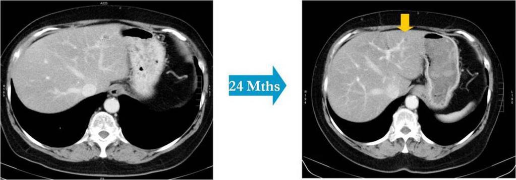 3%) of the 96 patients were excluded due to a short scan interval of 12 weeks. Follow-up imaging of 90 (15.