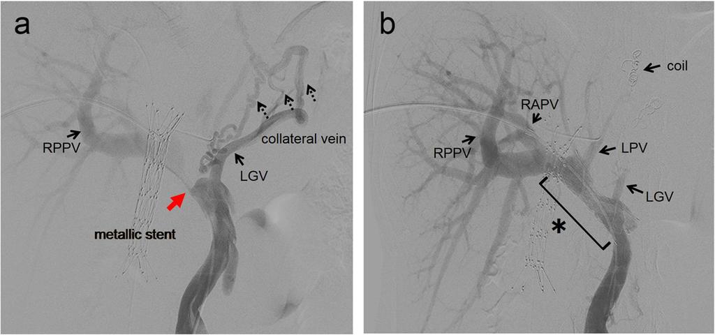 Yamada et al. Surgical Case Reports (2016) 2:19 Page 3 of 5 Fig. 2 Portography. a Portal vein stenosis (a red arrow) with collateral veins from the left gastric vein are shown (dotted black arrows).