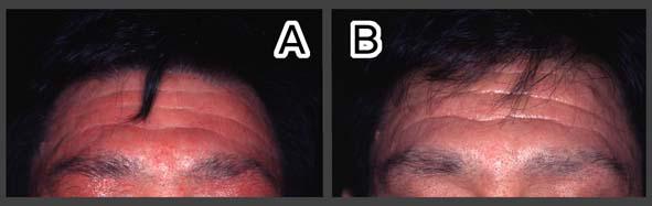 Figure 7 Eczema in a healing regimen The red area of skin in inflammation seen in image A is remarkably reduced in B. 3.