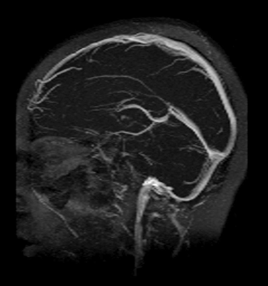 infarction on the right side of the central region. Fig.