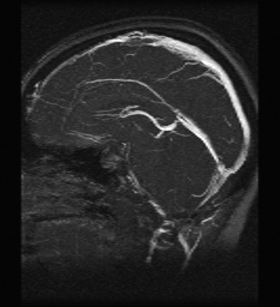 resonance angiography demonstrated thrombosis of the superior sagittal sinus. Fig.