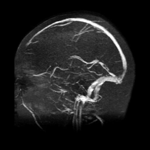 right-sided hemiparesis, which quickly resolved.